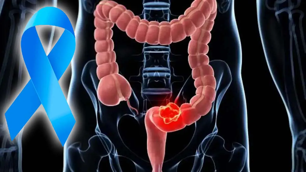cancer colon